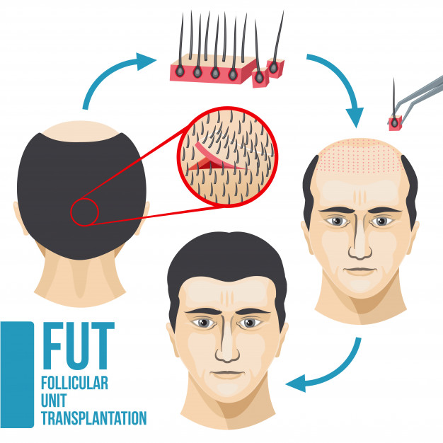 تقنية FUT لزراعة الشعر
