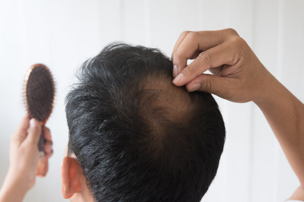 تساقط الشعر عند الرجال أسبابه وعلاجه