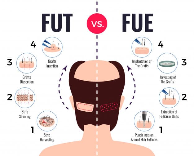 تقنيات زراعة الشعر FUT FUE