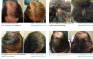 8 أشياء يجب معرفتها عن البلازما لتساقط الشعر
