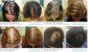 8 أشياء يجب معرفتها عن البلازما لتساقط الشعر